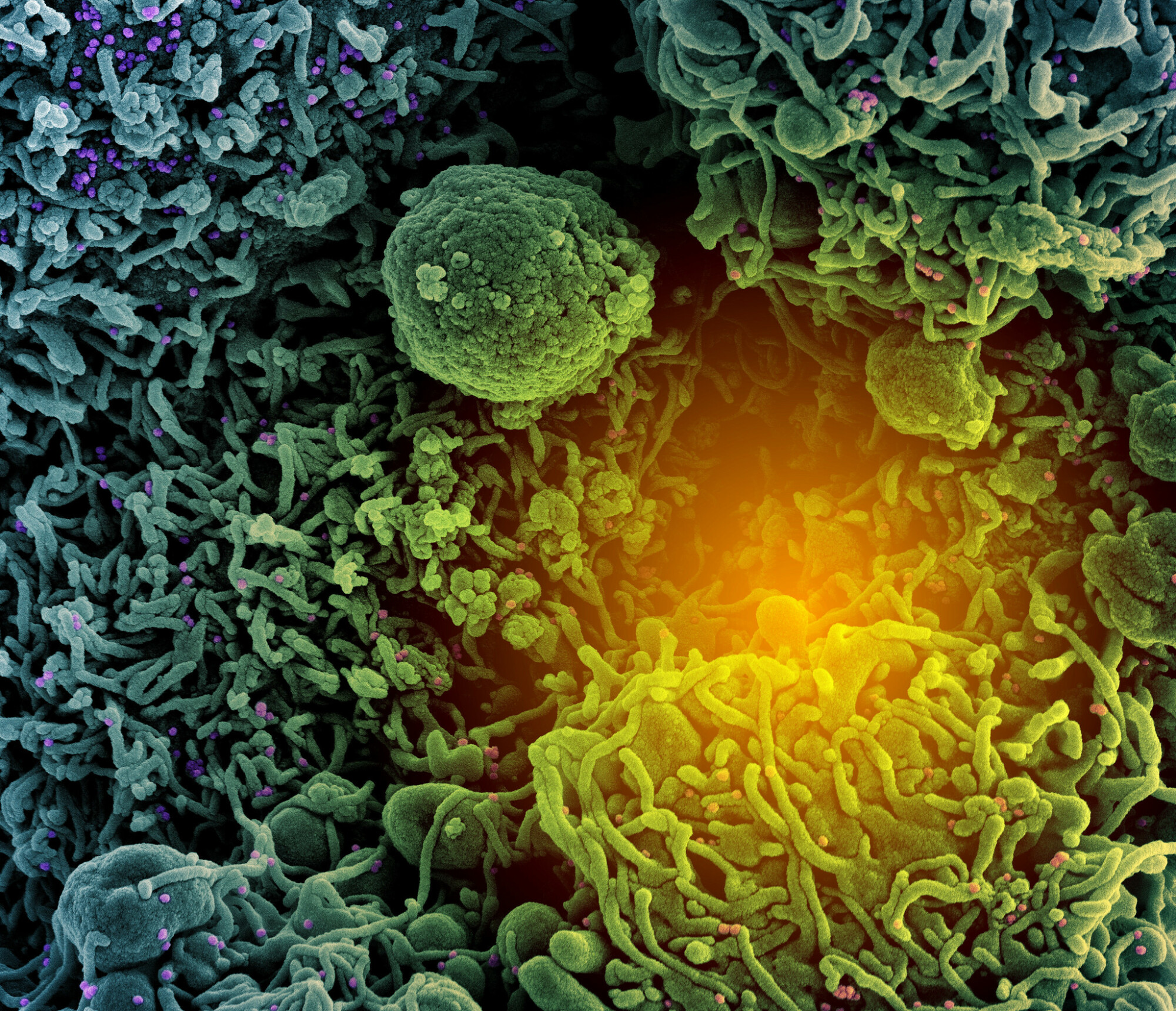 An electron micrograph image of a COVID patient's cell (teal and green) infected with SARS-CoV-2 virus particles (purple and pink).