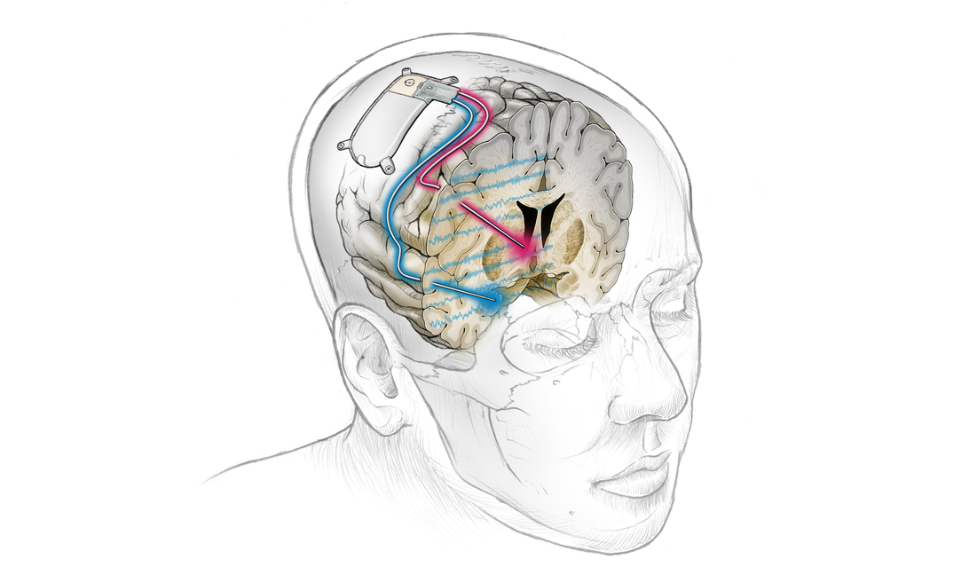 Closedloopdbs-cerebro-03sensestimsignal.png